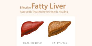 Read more about the article Ayurvedic Treatment of Fatty Liver with Powerful Herbs